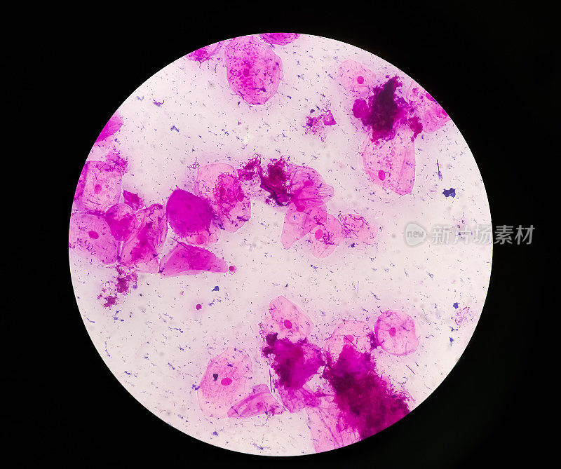 前列腺涂片(P/S)革兰氏染色镜下100x可见少量脓细胞和上皮细胞。革兰氏阳性双球菌数量多，革兰氏阴性杆状细菌数量少。